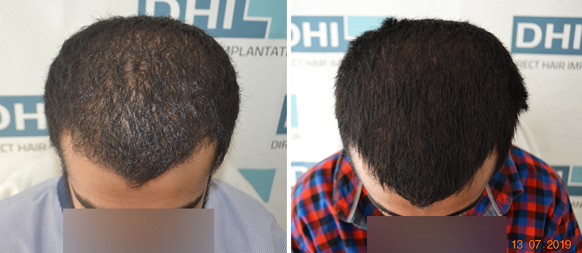 DHI before & after hair transplant results